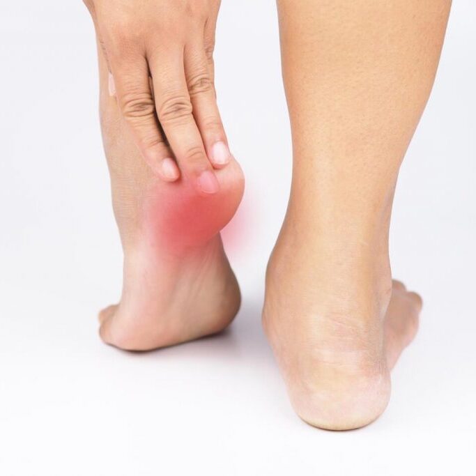 plantar-fasciitis