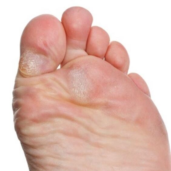 repeated-pressure-corns