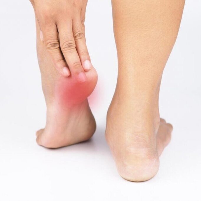 plantar-fasciitis